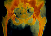 False-colour x-ray of pelvis & upper legs