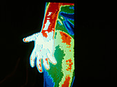 Thermogram of hand of rheumatoid arthritis patient