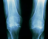 Tinted X-ray of rheumatoid arthritis in the knees