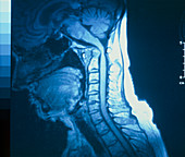 MRI scan of rheumatoid arthritis of neck