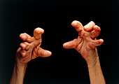 Hands affected by rheumatoid arthritis