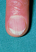 Ridged nail in patient with rheumatoid arthritis