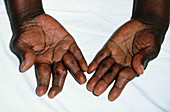 Rheumatoid arthritis in hands of Jamaican patient