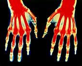 Col. X-ray of rheumatoid arthritis in both hands