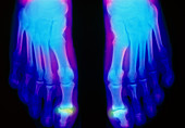 False-colour X-ray of feet: rheumatoid arthritis