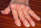 Deformed hand due to rheumtoid arthritis