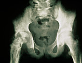 X-ray of septic arthritis in the hip