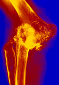 Col X-ray of rheumatoid arthritis of the elbow