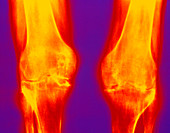 X-ray of rheumatoid arthritis in knees