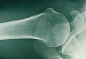 X-ray of shoulder joint,calcification of tendon