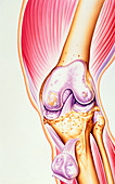 Artwork of osteoarthritis of knee joint