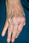 Rheumatoid arthritis of hand with ulnar deviation