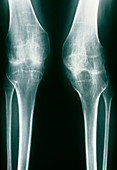 X-ray of knees juvenile arthritis