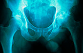 X-ray of osteoarthritis of the hip