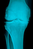 X-ray view of knee joint with osteoarthritis