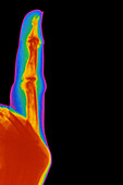 Coloured X-ray of finger with rheumatoid arthritis