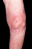 Elderly woman's knee affected by osteoarthritis