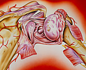 Artwork of an rheumatoid arthritis of the shoulder