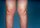 View of knees affected by osteoarthritis