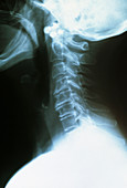 Osteoarthritis of the neck