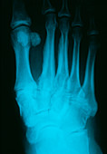 Osteoarthritis of foot,X-ray