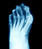 Arthritic foot,X-ray