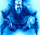 Arthritic hip,X-ray