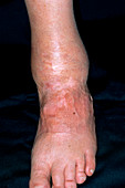 Arthritis of the ankle