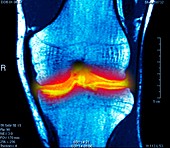 Joint disease,CT scan