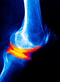 Joint disease,X-ray
