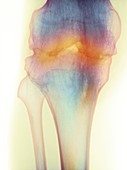Fused knee joint,X-ray