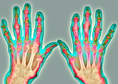 Arthrosis of the hand,X-ray