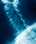 Arthritic neck,X-ray