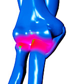 Arthritic elbow,computer artwork