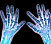 Arthritic hands,X-ray