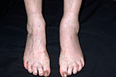 Arthritic ankle