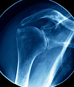 Arthritic shoulder,X-ray