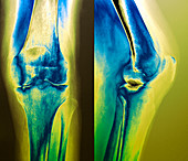 Arthritic knee,X-ray