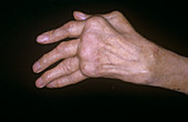 Arthritic hand
