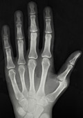 Arthritic hand,X-ray
