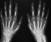 Arthritic hands X-ray