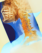 Osteoarthritis of the neck,X-ray