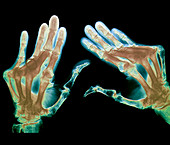 Arthritic hands,X-ray