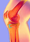 Osteoarthritis of the knee,X-ray