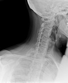 Osteoarthritis of the neck,X-ray