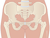 Osteoarthritis of the hips,artwork