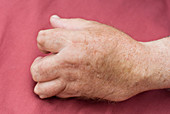 Rheumatoid arthritis