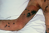 Kaposi's sarcoma on the arm and chest,in AIDS