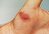 Kaposi's sarcoma on the hand of an AIDS patient
