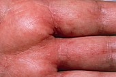 Scabies rash on hand of AIDS patient